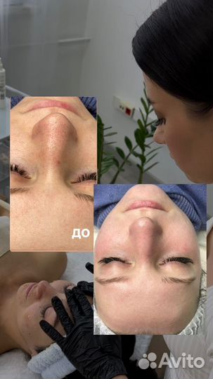 Чистка лица