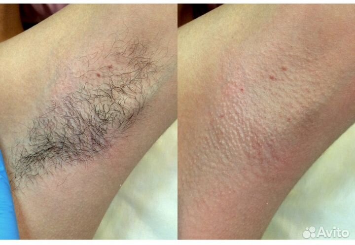 Шугаринг с выездом