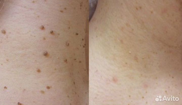 Удаление папиллом, родинок, бородавок