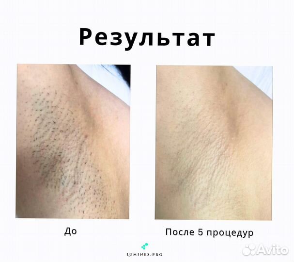 Диодный лазер Лю’минес Макс’Ван 1200в