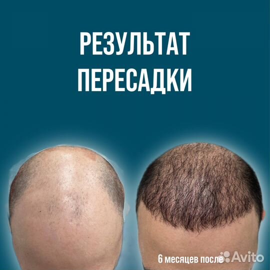 Пересадка волос по современной методике