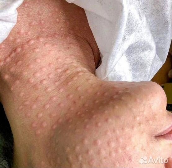 Чистки лица,пилинги,мезо и биоревитализация