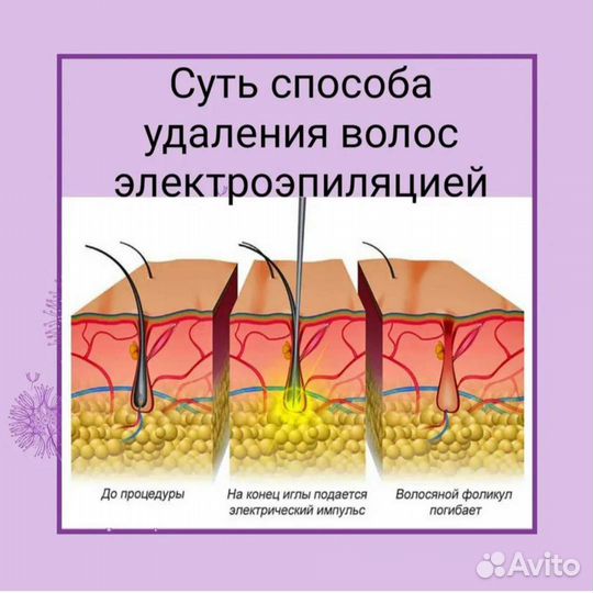 Электроэпиляция