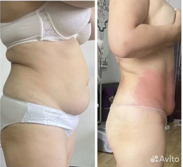 Безоперационная липосакция