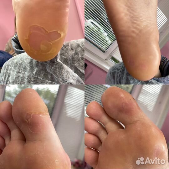 Медицинский педикюр (подология )