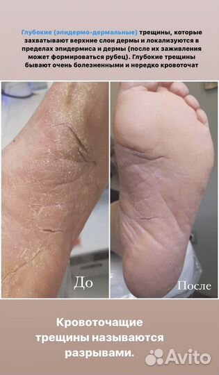 Подолог. Медицинский педикюр