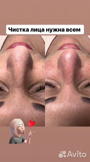 Услуги косметолога чистка лица пилинг