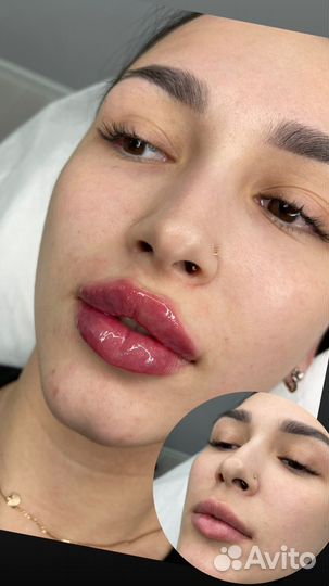 Контурная пластика губ