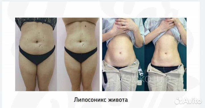Смас Лифтинг