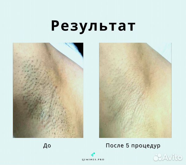 Диодный лазер для эпиляции Lumines Макс Ван 1200в