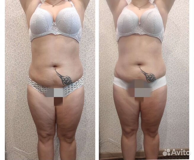 Антицеллюлитный массаж