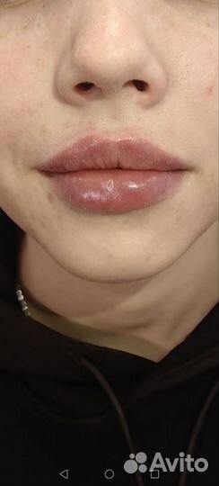 Увеличение губ