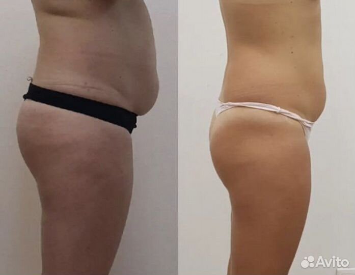 Похудеете аппаратный массаж Скетч