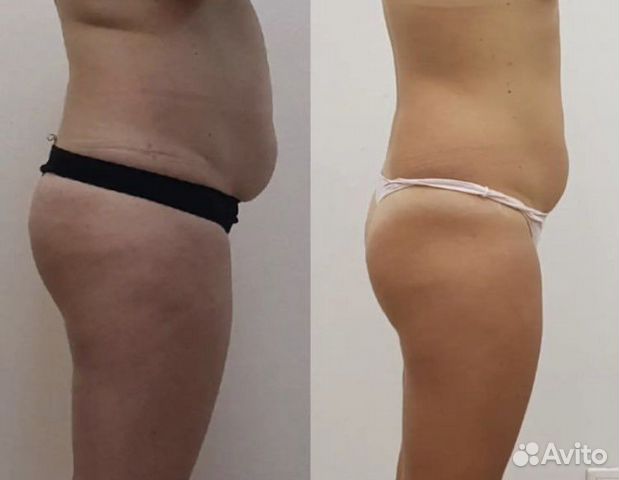 Похудеете аппаратный массаж Скетч