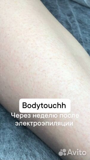 Электроэпиляция