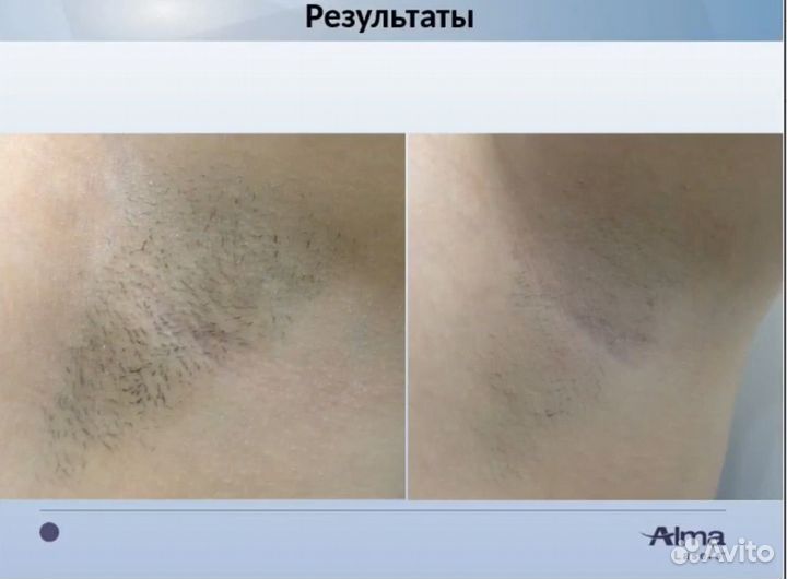 Лазерная эпиляция