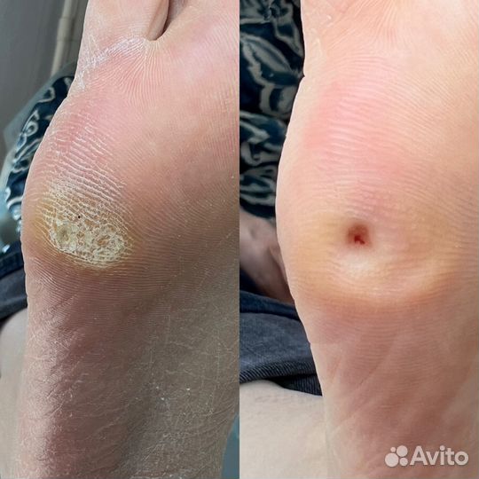 Медицинский педикюр