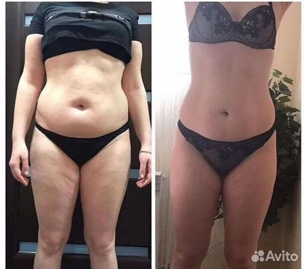 Удаление жира, криолиполиз в Перми