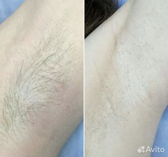 Электроэпиляция удаление волос навсегда