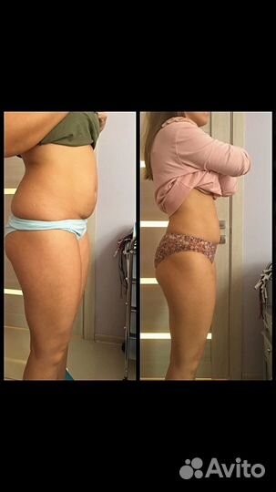 Антицеллюлитный массаж