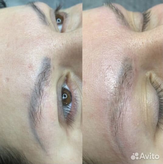 Удаление татуажа и тату