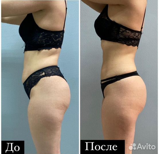 Модель, коррекция фигуры EMS