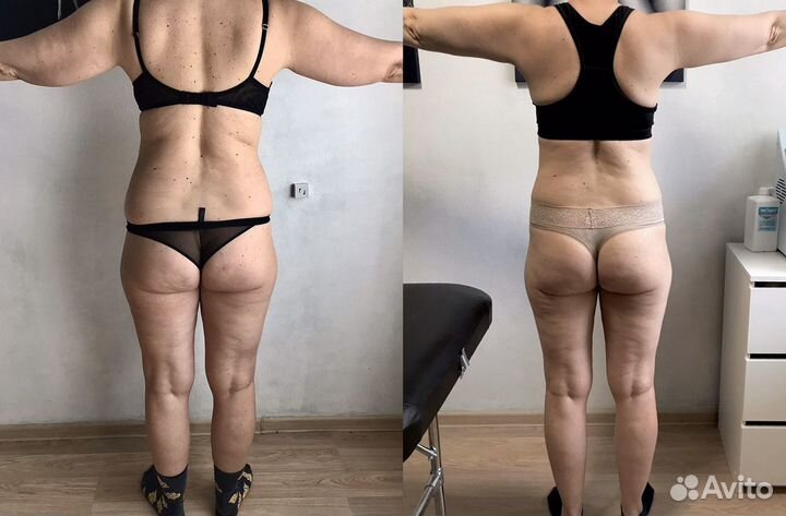 Массаж, похудение