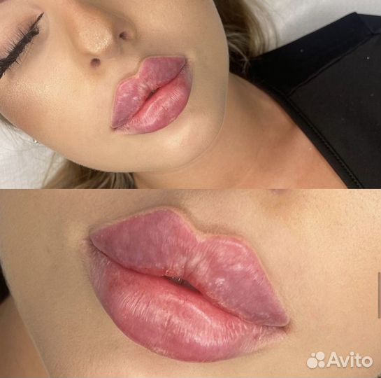 Увеличение губ