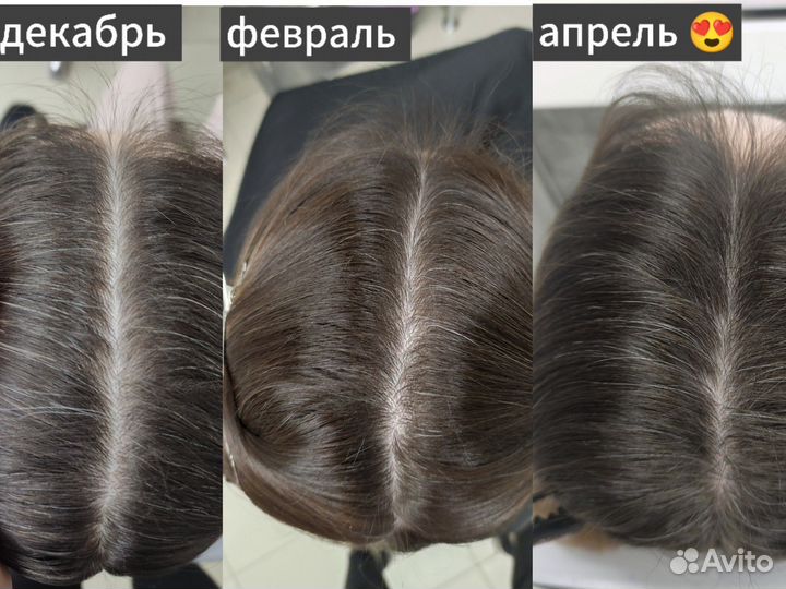 Трихолог-эстетист выпадение/восстановление волос