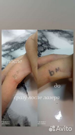 Лазерное удаление татуировок
