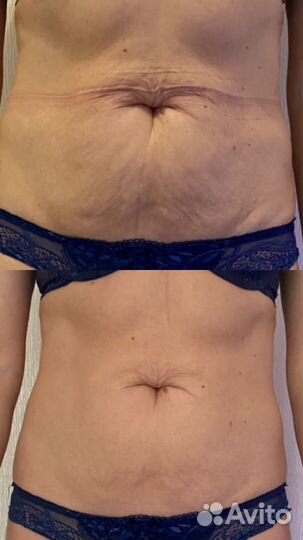 Аппаратный массаж R-Sleek Балтийская Жемчужина