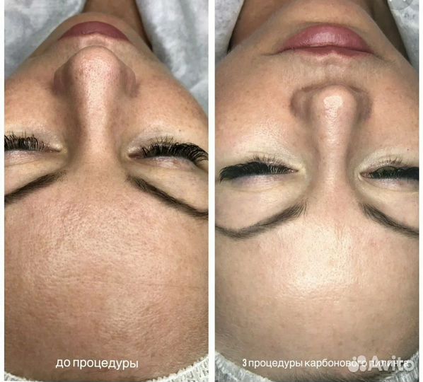 Карбоновый пилинг аппарат