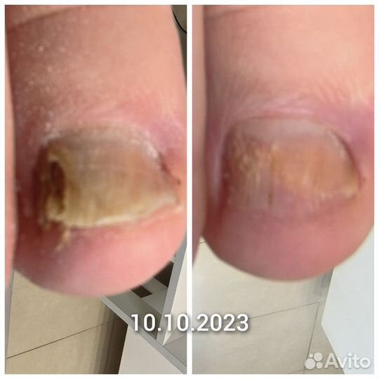 Медицинский педикюр, подолог