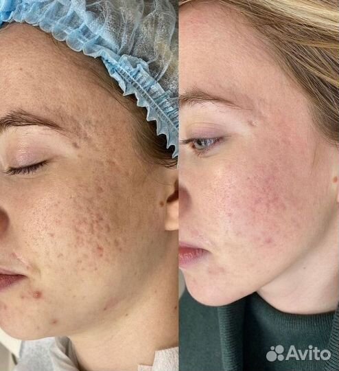 Косметолог / Акне / Чистка /Пилинг