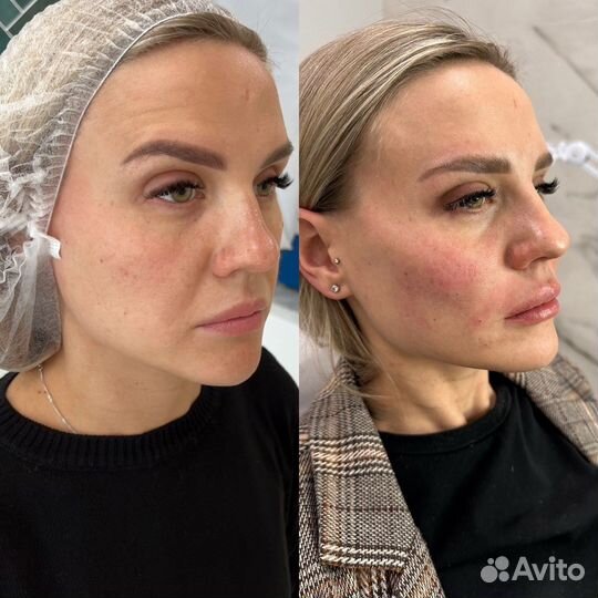 Подтяжка лица эффект с 1 процедуры