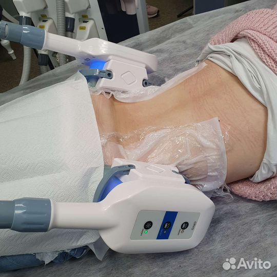 Криолиполиз