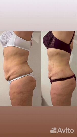 Аппаратная коррекция фирмы, массаж