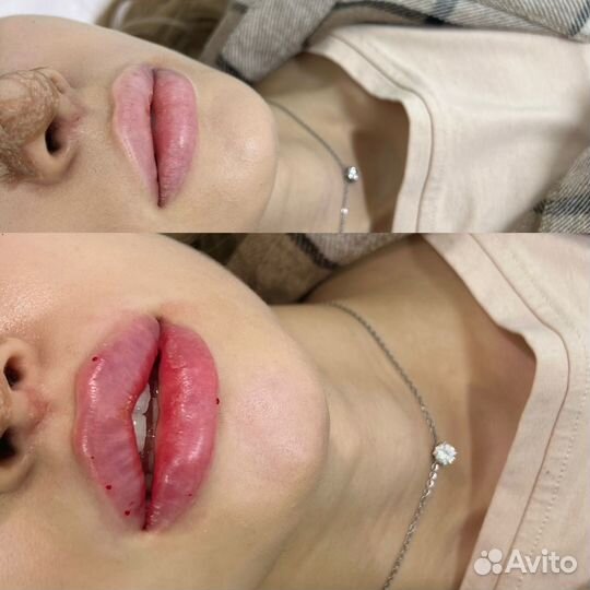 Косметлог увеличение губ