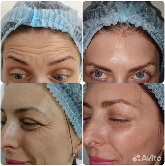 Коррекция морщин. Ботокс