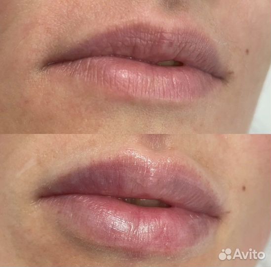 Косметолог, ботокс для лица, увеличение губ