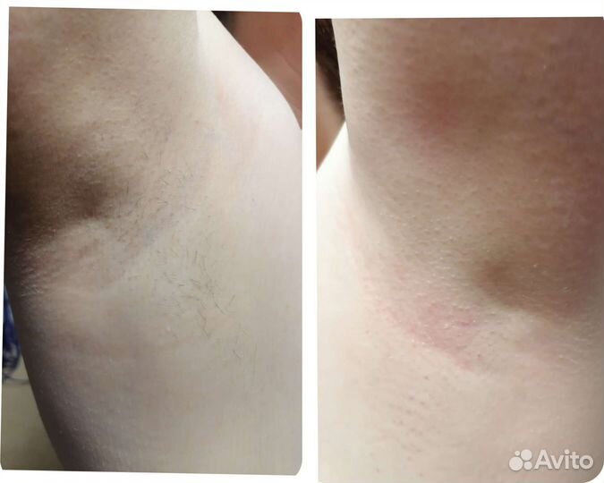 Миостимуляция и антицеллютный массаж, обертывания