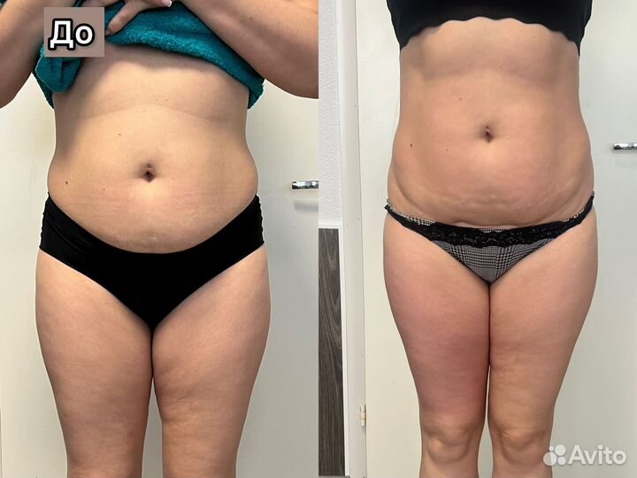 Коррекция фигуры Индиба Похудение