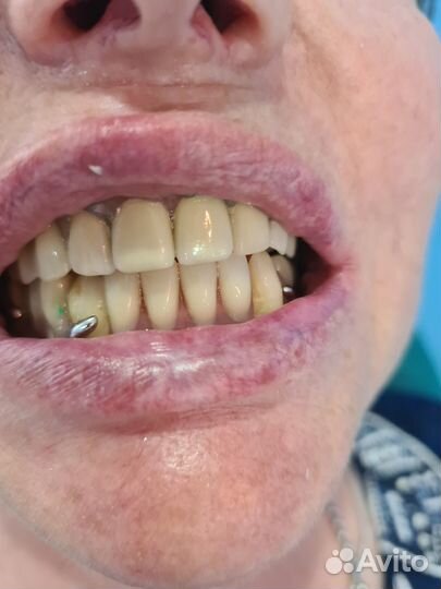 Изготовление съёмных протезов