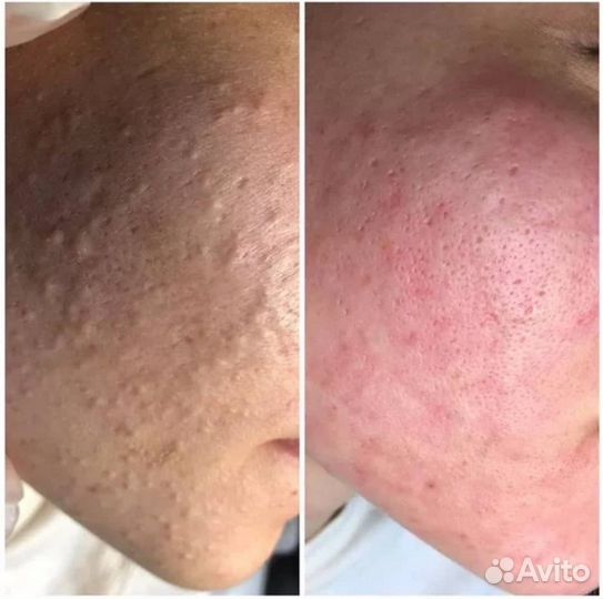 Чистка лица, пилинг, уход, на премиум препаратах