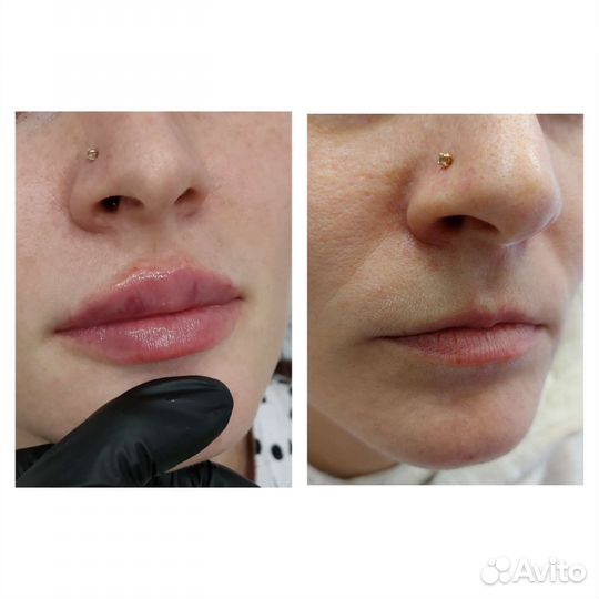 Увеличение губ,косметолог, ботокс