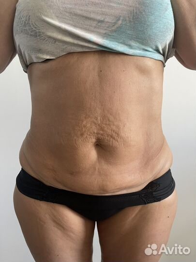 Микроигольчатый РФ