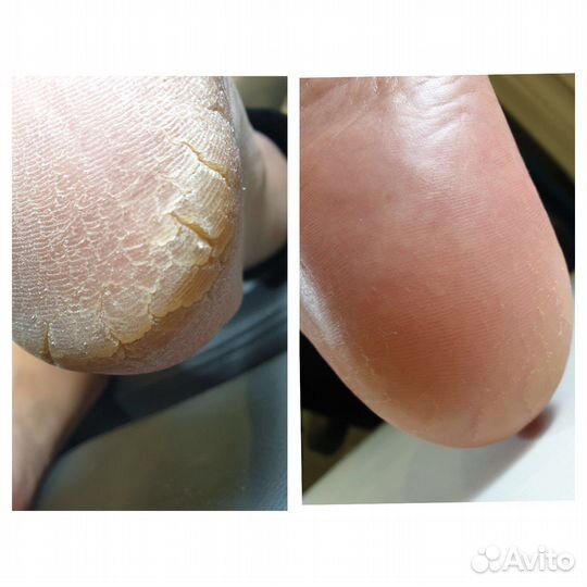 Педикюр,выезд на дом