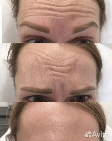 Требуются модели на Smas лифтинг