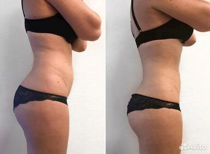 Вакуумно-роликовый массаж starvac