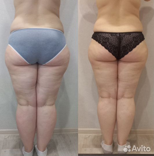 Антицеллюлитный массаж,коррекция фигуры,кавитация